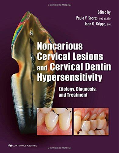 Buy Noncarious Cervical Lesions and Cervical Dentin Hypersensitivity ...