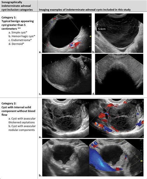 Indeterminate Adnexal Cysts at US: Prevalence and Characteristics of Ovarian CancerRadiology
