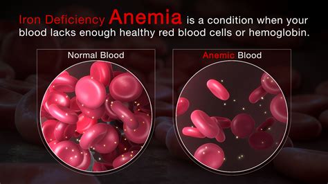 Iron Deficiency Anemia Rash at Leonard Gagliano blog