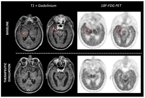 Role of Positron Emission Tomography in Primary Central Nervous System ...
