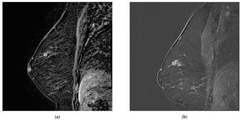 Missed Breast Cancers on MRI in High-Risk Patients: A Retrospective ...