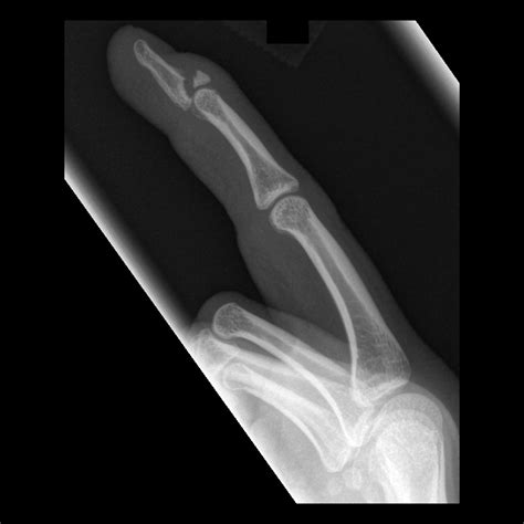 Pediatric Mallet Finger Fracture | Pediatric Radiology Reference ...