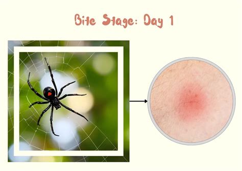 Southern Black Widow Spider Bite: Stages, Symptoms with Pictures