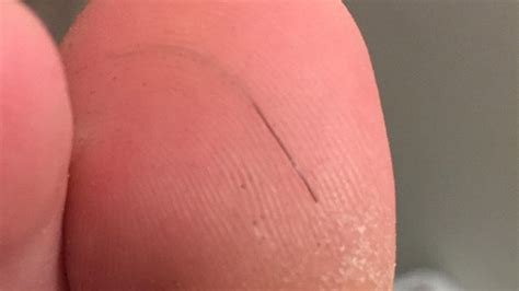 Image result for Hair Splinter Infection