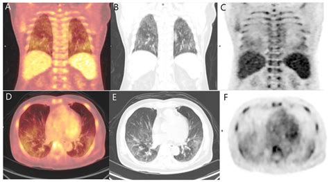 Metastatic Pulmonary Calcification Detected on 18F-FDG PET/CT and 99mTc ...