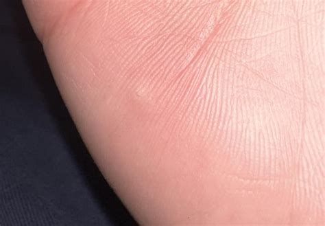 Image result for Splinter in Hand