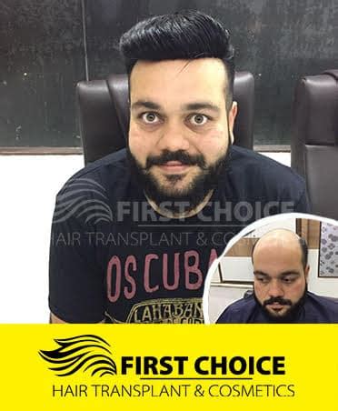 Hair Patches, Hair Fixing, wig and Extensions cost in Ludhiana, Punjab