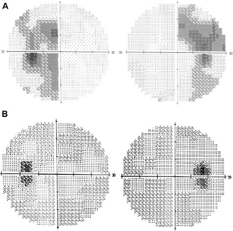 Image result for Paracentral Visual Field Defect