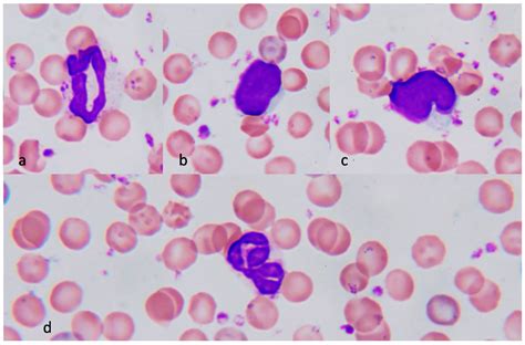 Nucleated Red Blood Cells Vs Lymphocyte