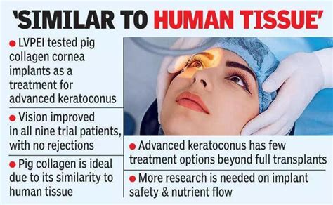 Pig tissue cornea implants offers new treatment for advanced ...