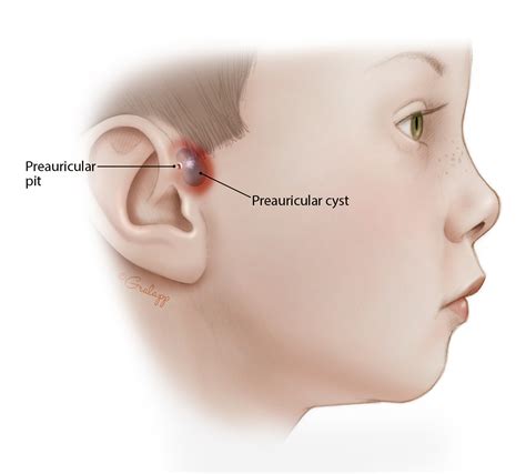 Infected Sebaceous Cyst Behind Ear