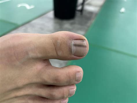 black streak on toe nail a- what could this be a sign of? : r/medical