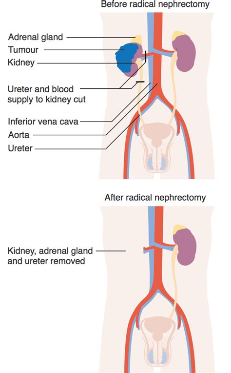 Image result for Nephrectomy Approach