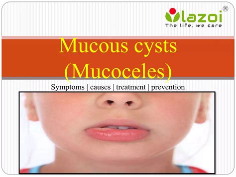 Mucous cysts (Mucoceles): Symptoms, causes, treatment and preventions. | PPTX