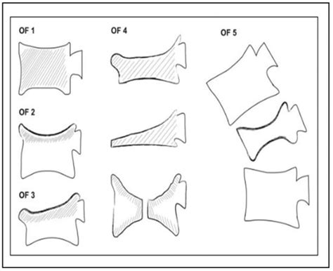 Multidisciplinary and Coordinated Management of Osteoporotic Vertebral ...