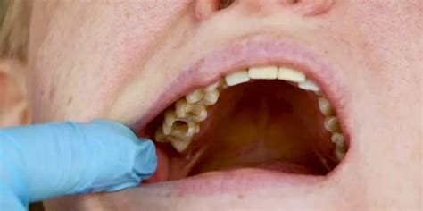 Image result for Tooth Hole