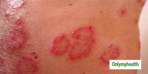 Types Of Psoriasis in Hindi | सोरायसिस के इन 6 प्रकार के बारे में जानकर ...