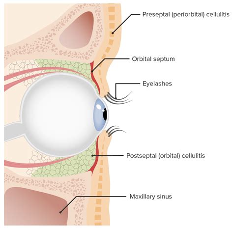 Orbital and Preseptal Cellulitis | Concise Medical Knowledge
