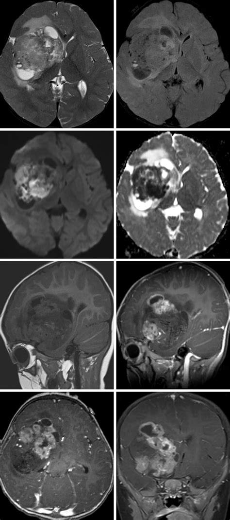 Atypical Teratoid-Rhabdoid Tumor | The Neurosurgical Atlas