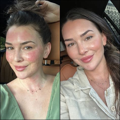 Microneedling Before And After 1 Session