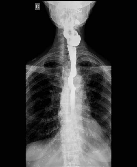Radiology Zenker's Diverticulum at Russell Stinson blog