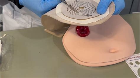 Image result for Pouchoscopy Prep