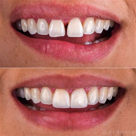 Pros and Cons of Invisalign and Traditional Braces - DR. DANIB