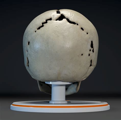 Custom 3D Anatomy Models | Craniosynostosis | Coronal Suture | Brachycephaly | Pfeiffer Syndrome ...
