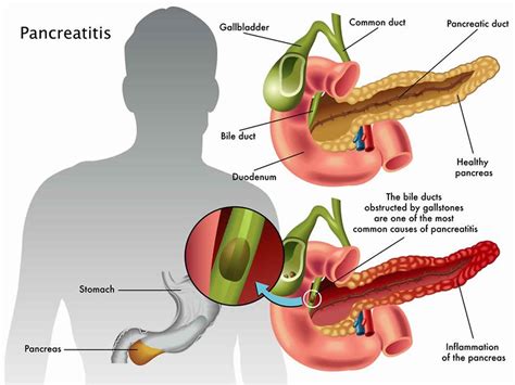Pancreatitis, causes, signs, symptoms, diagnosis, treatment & prognosis