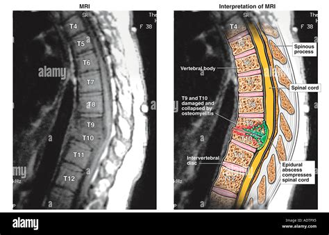 Spinal Cord Compression 的图像结果