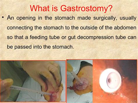 Gastrostomy | PPT