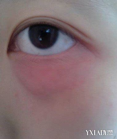【图】眼睑红肿是怎么回事 一般并无明显症状_伊秀美容网|yxlady.com