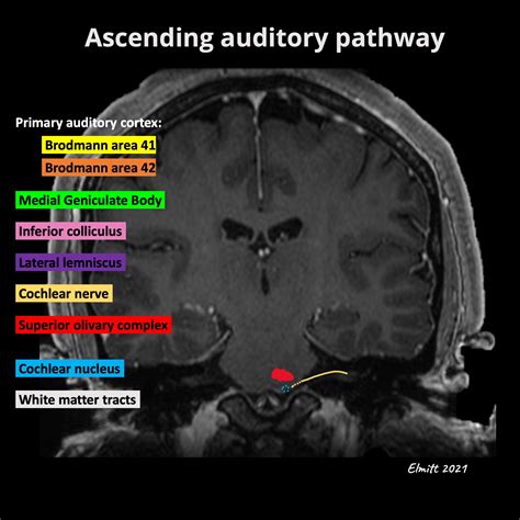 Auditory Cortex Mri