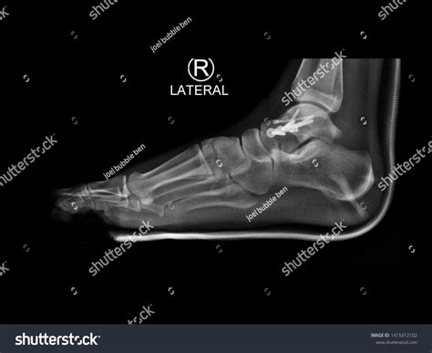 Film Lateral Foot X-ray Radiograph Showing ภาพสต็อก 1415312102 ...
