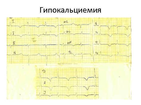 Изменения ЭКГ при нарушениях обмена веществ и заболеваниях