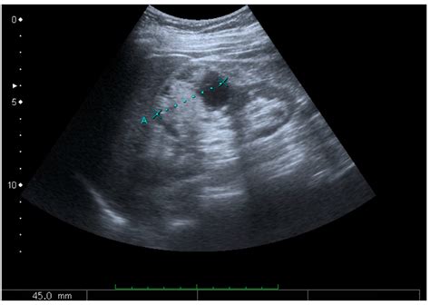 Ultrasonography of the Kidney: A Pictorial Review