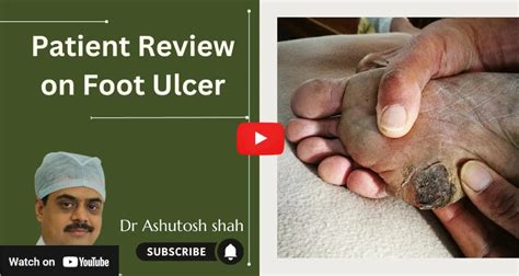 Diabetic NRIs Trust Our Clinics for Expert Foot Care