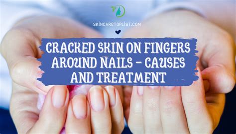 Cracked Skin on Fingers Around Nails - Causes and Treatment | Skincare ...