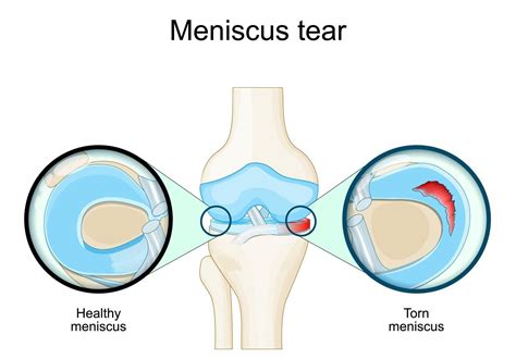 Meniscus Tear Treatment & Rehab in St. Pete, FL - Alliance Regen & Rehab