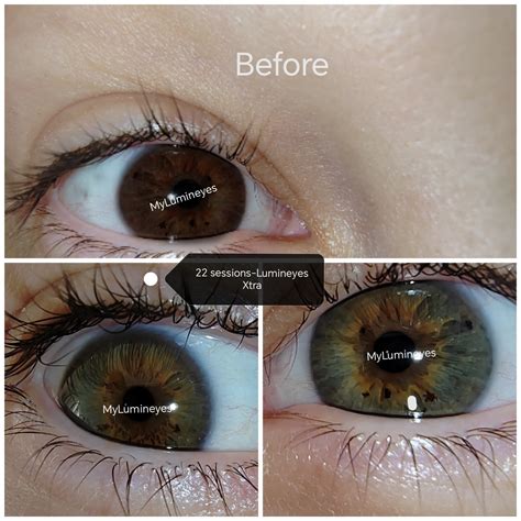 Can You Medically Change Your Eye Color at Rebecca Hart blog