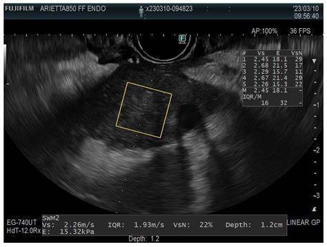 Endoscopic Ultrasound (EUS) Guided Elastography