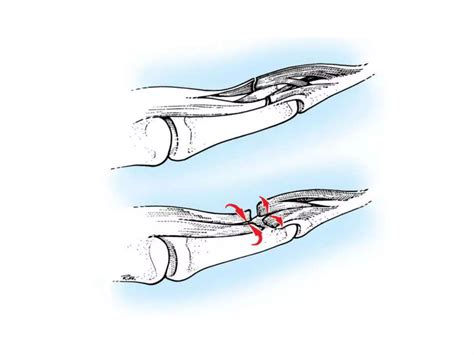 Flexor tendon injuries.m | PPTX
