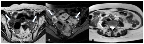 Manifestations of Ovarian Cancer in Relation to Other Pelvic Diseases ...