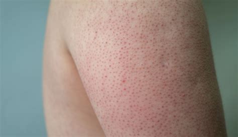 5 Must Try Home Remedies To Treat Strawberry Skin - lifeberrys.com