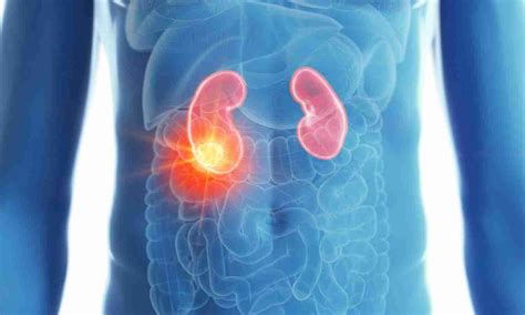 Subcutaneous Nivolumab as Effective as IV injection for Renal Cell ...