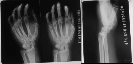 手掌掌骨骨折 手掌骨骨折的后期恢复 手掌骨骨折 什么方法可以快速痊愈?急!!!_第二人生