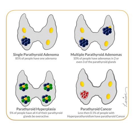 Hyperparathyroidism Causes & Treatment Options - parathyroid