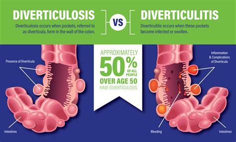 Diverticulitis Vs. Diverticulosis: What’S The Difference – Bang Bus