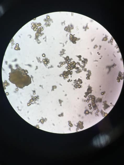 Leucine Crystals In Urine Sediment