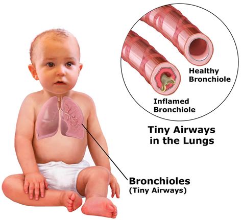 Bronchiolitis causes, prevention, symptoms, diagnosis and treatment